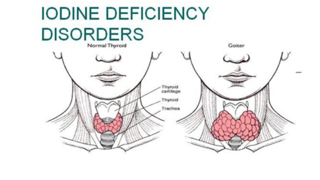 deficiency of iodine in the body