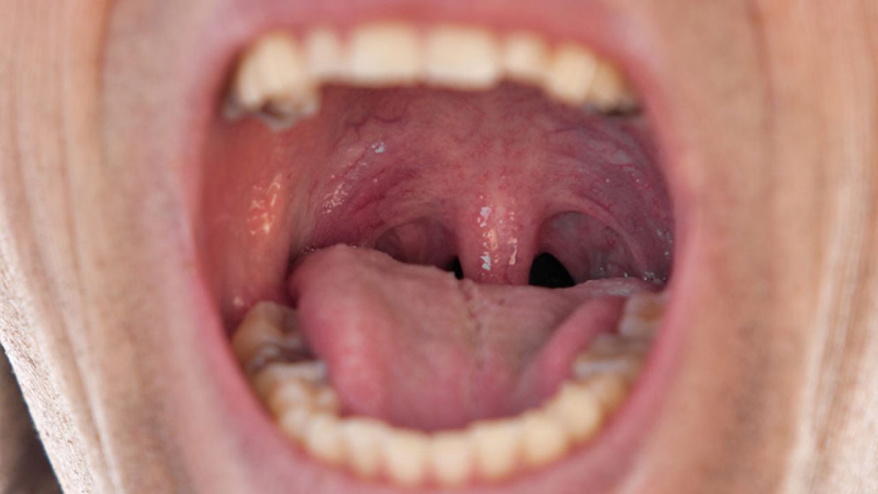 hpv throat cancer signs and symptoms)